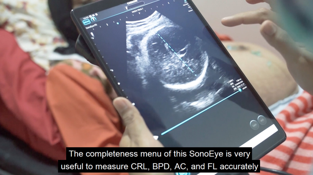 Historia de SonoEye | Viaje de SonoEye con una partera en Indonesia Historia de SonoEye | Viaje de SonoEye con una partera en Indonesia