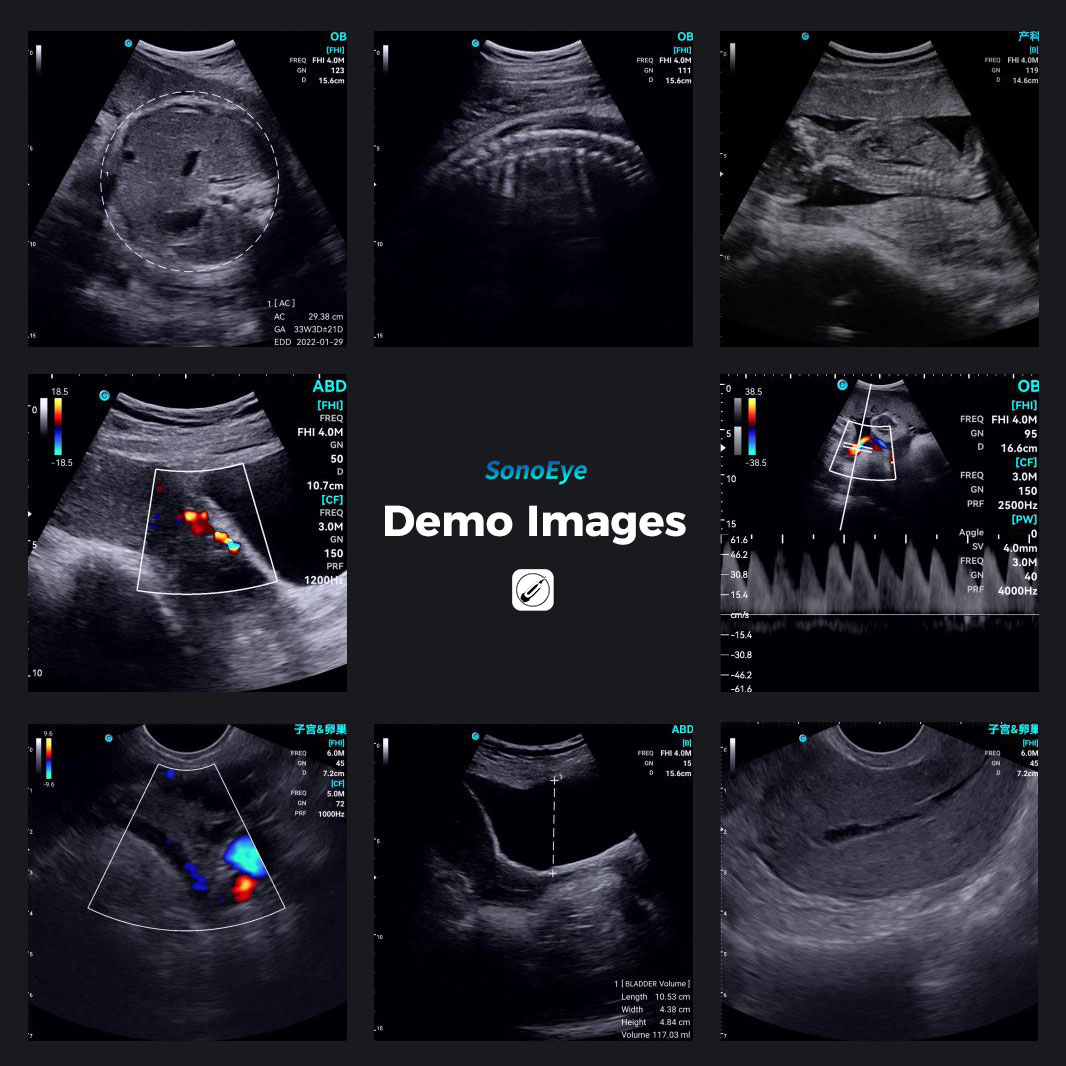 La visión de CHISON SonoEye para potenciar la salud de las mujeres. La visión de CHISON SonoEye para potenciar la salud de las mujeres.