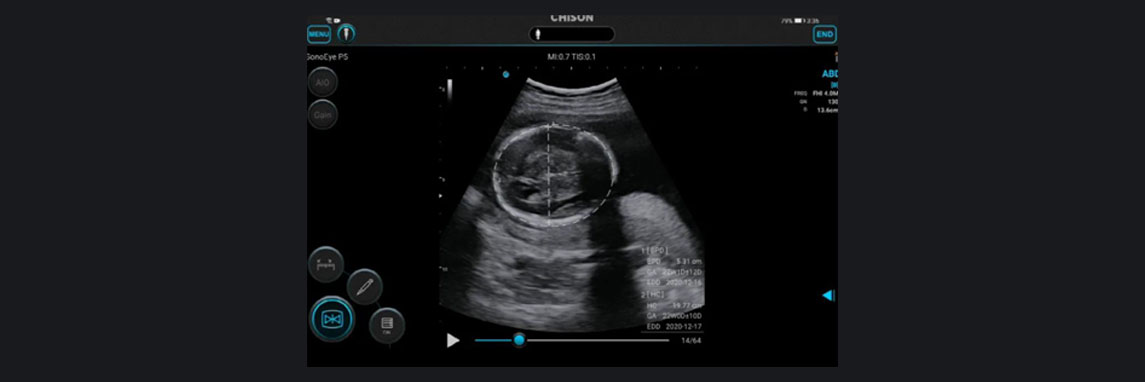 La visión de CHISON SonoEye para potenciar la salud de las mujeres. La visión de CHISON SonoEye para potenciar la salud de las mujeres.
