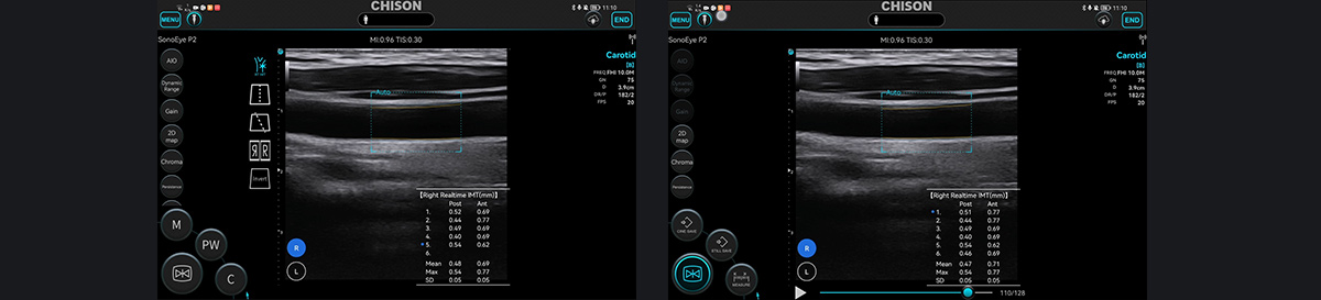 SonoEye 在血管超声中的应用 SonoEye 在血管超声中的应用
