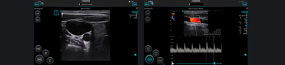SonoEye 在血管超声中的应用 SonoEye 在血管超声中的应用