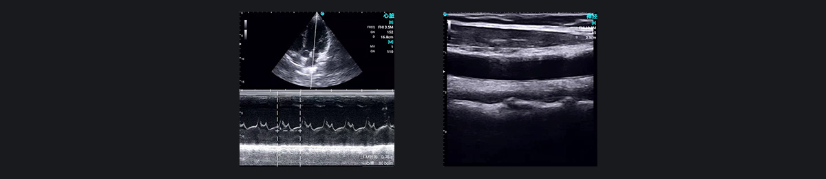 SonoEye 在麻醉中的应用