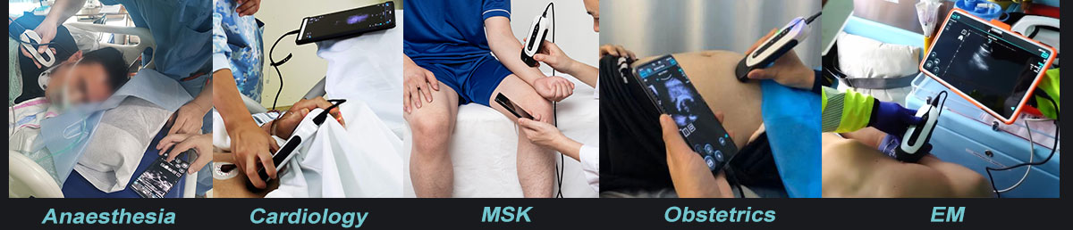 The Point-of-Care Ultrasound (POCUS) Revolution The Point-of-Care Ultrasound (POCUS) Revolution