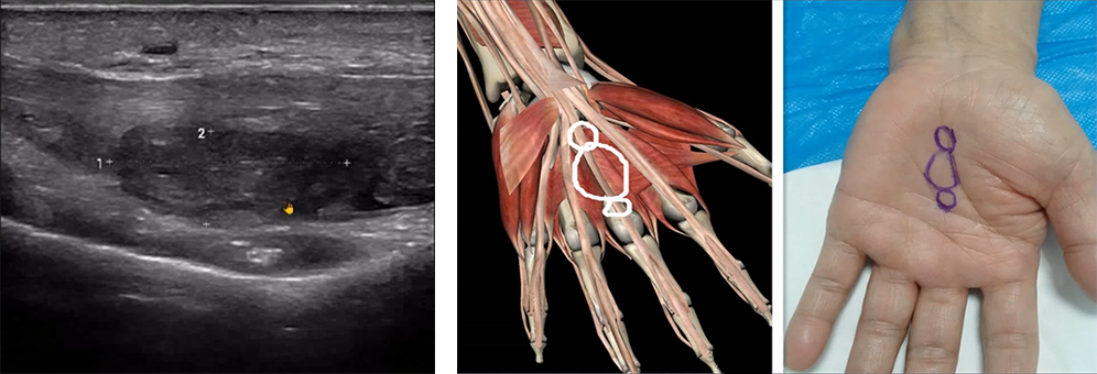 Case Studies in Wrist Ultrasound