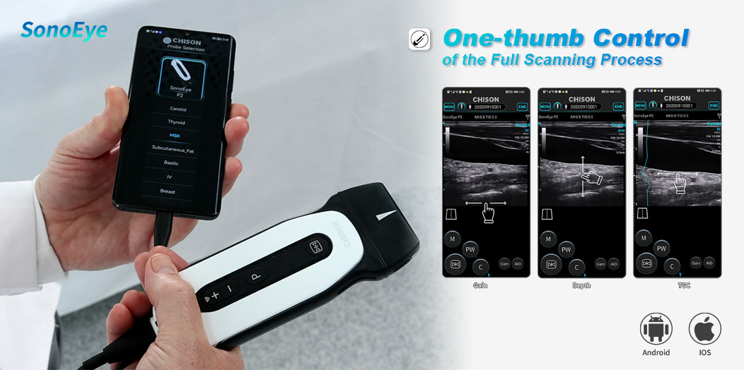 User-friendly Software Authoritative Findings: SonoEye Hailed as Premier Ultrasound Device